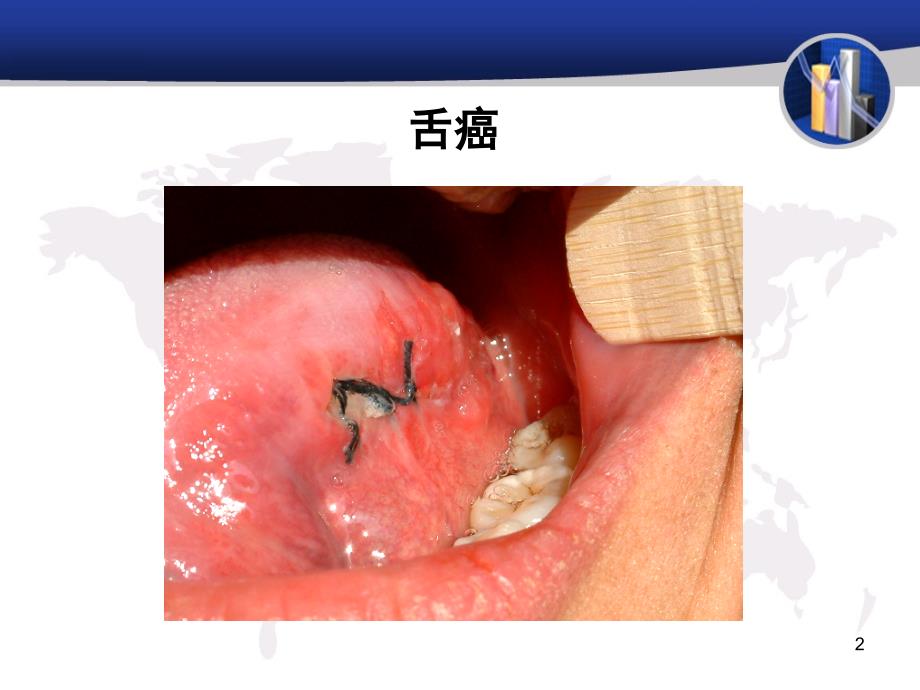 舌癌病人的护理PPT课件_第2页