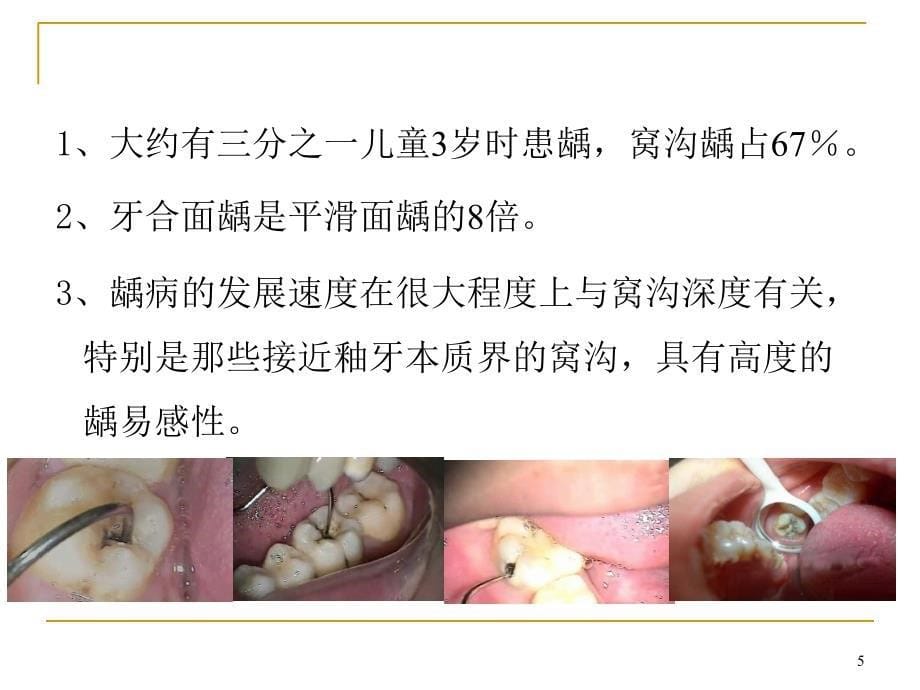 窝沟封闭培训 ppt课件_第5页