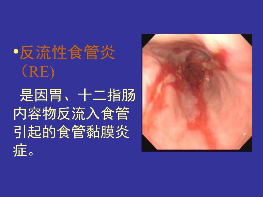 胃食管反流病诊断与治疗ppt课件_第3页