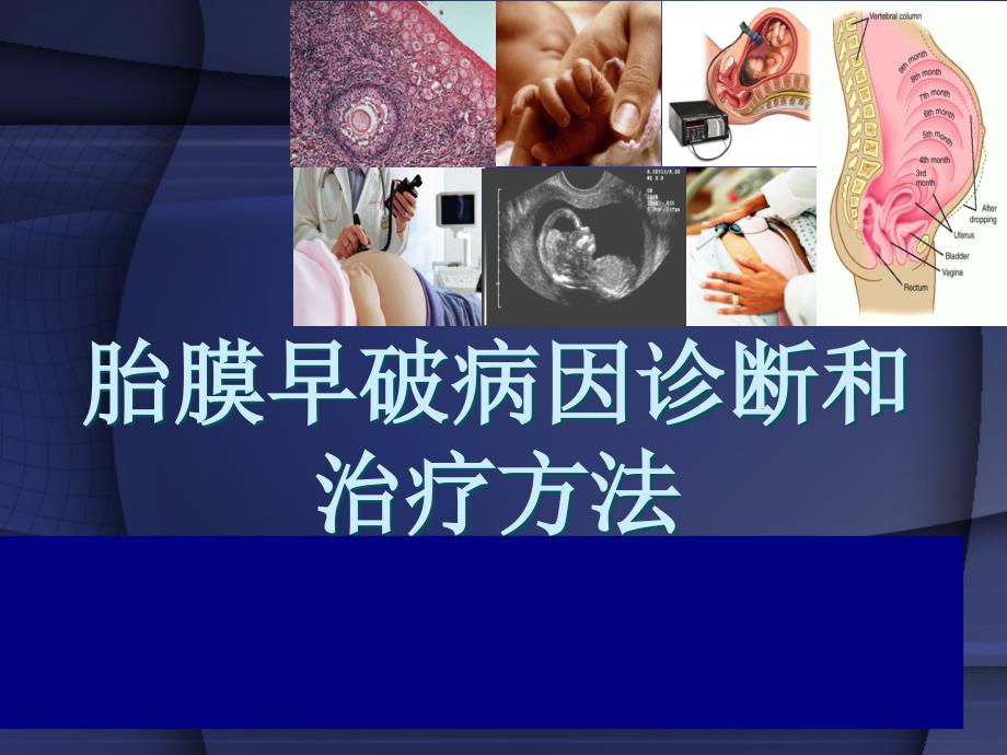 胎膜早破病因诊断和治疗方法PPT课件_第1页