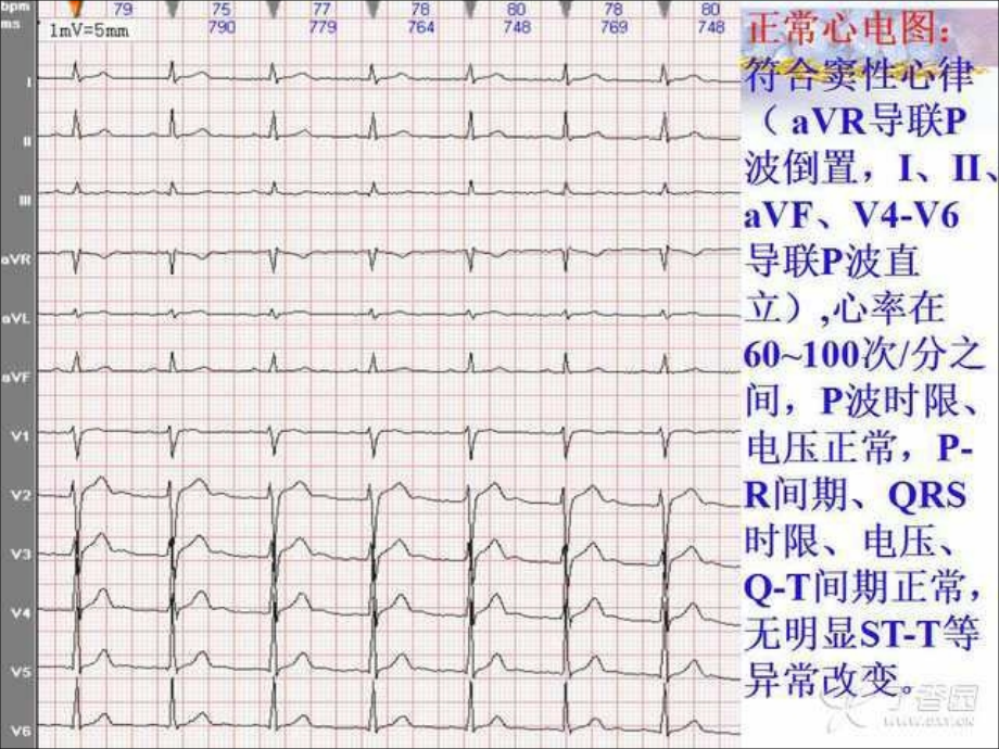 常见心电图诊断知识_临床医学_医药卫生_专业资料_第4页