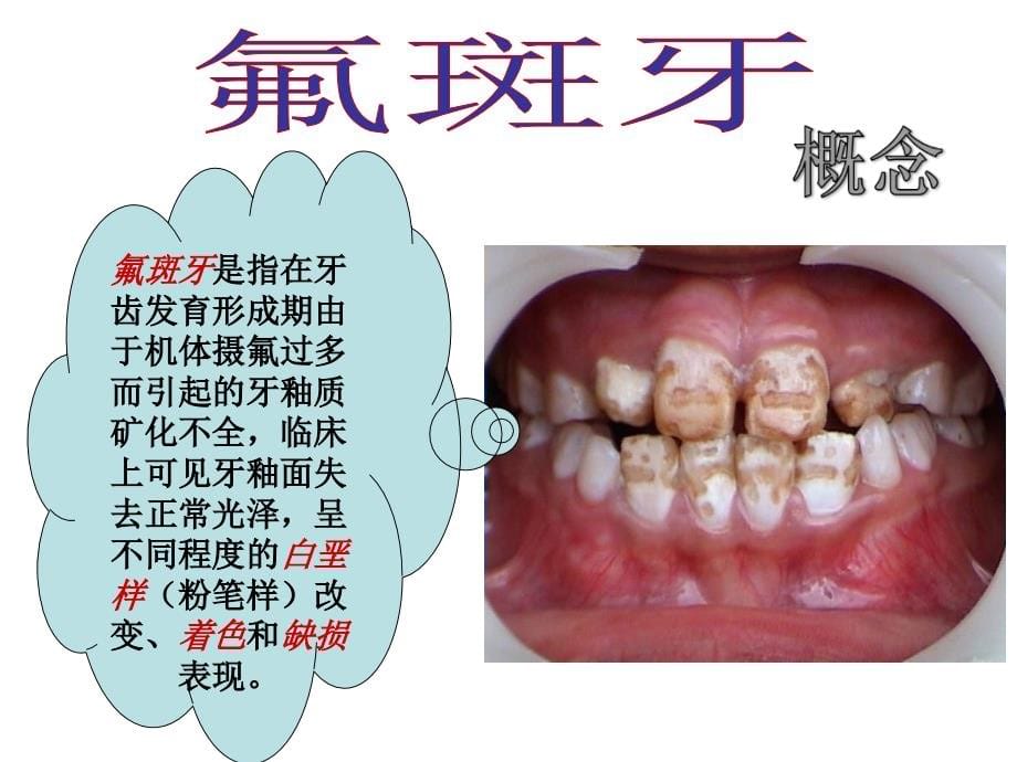 氟斑牙临床诊断20150520_第5页