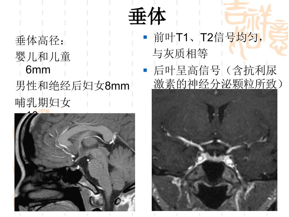 侵袭性垂体瘤mr征象分析ppt_第3页