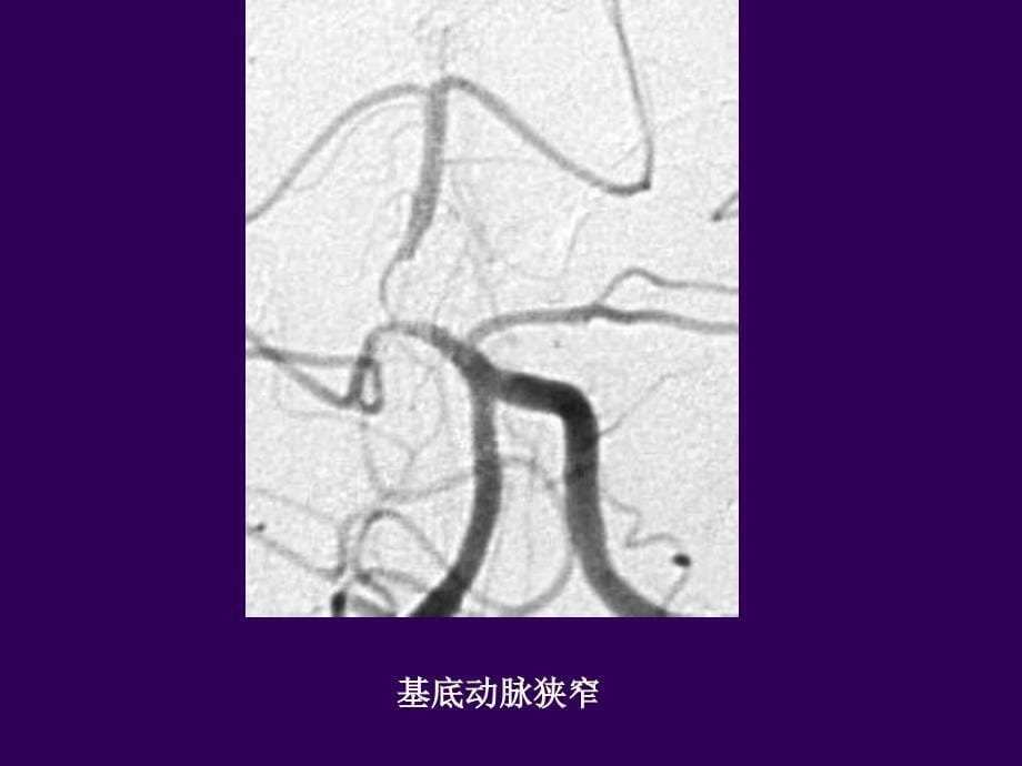 颅内动脉狭窄治疗的循证医学研究概况_刘鸣_第5页