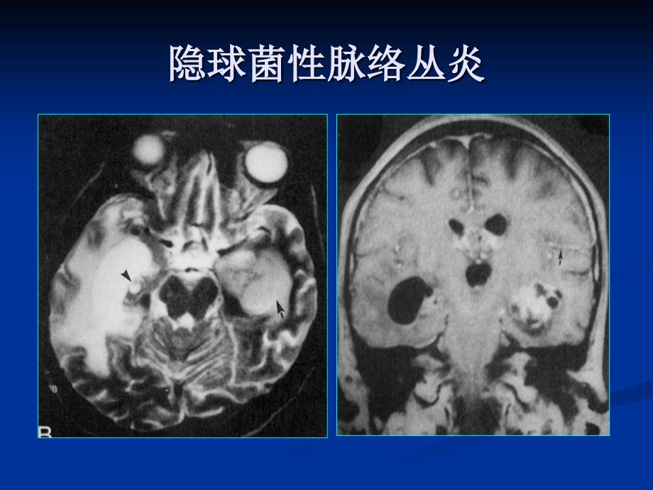 颅内感染性病变的影像诊断与鉴别诊断5ppt_第4页