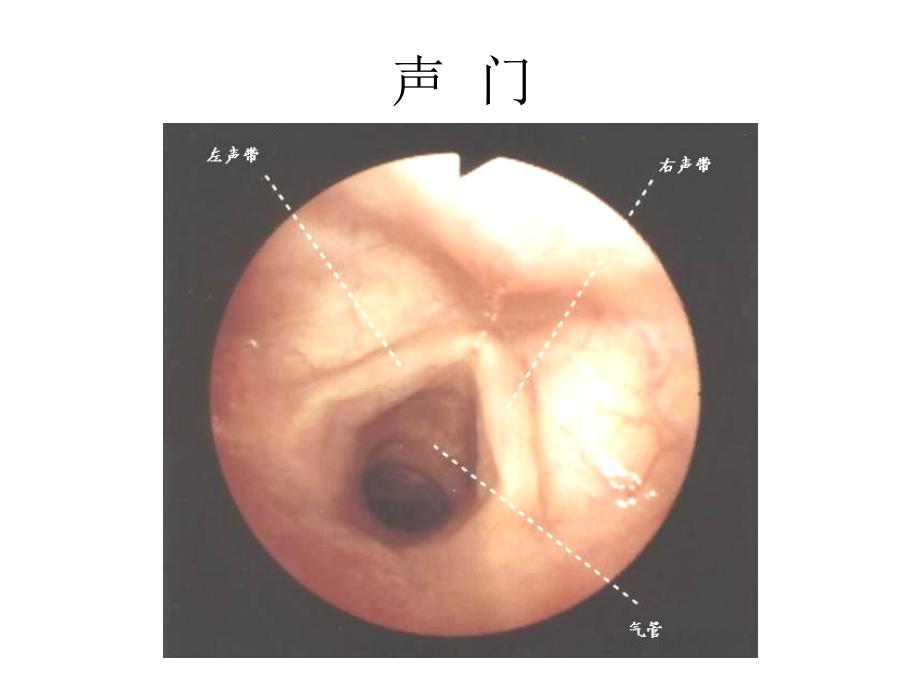 气管镜图谱 会   厌_第3页