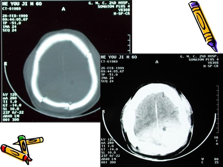 中枢神经系统ct诊断2  ppt课件_第5页
