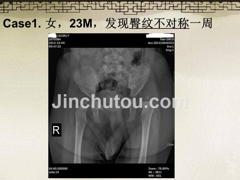 DDH发育性髋关节脱位_第1页