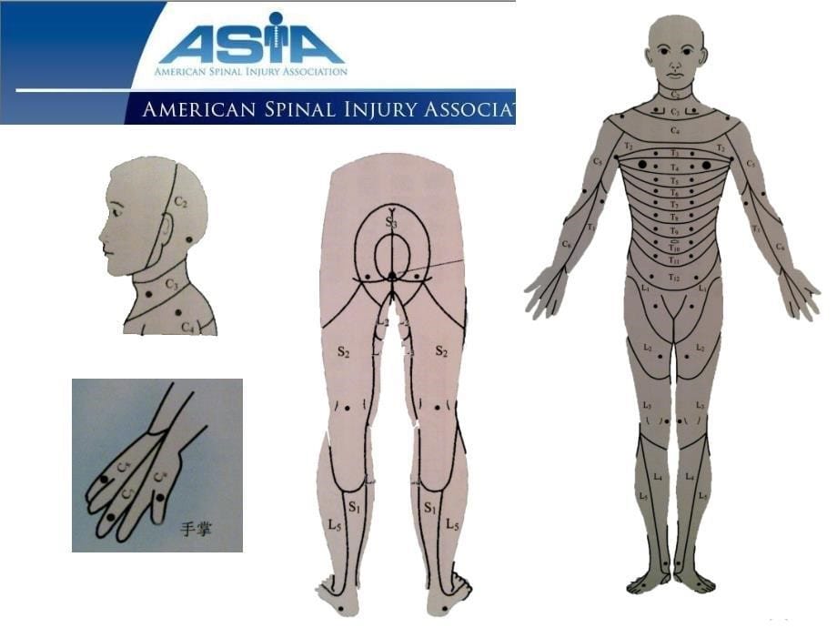 ASIA脊髓损伤的标准神经学分级_第5页