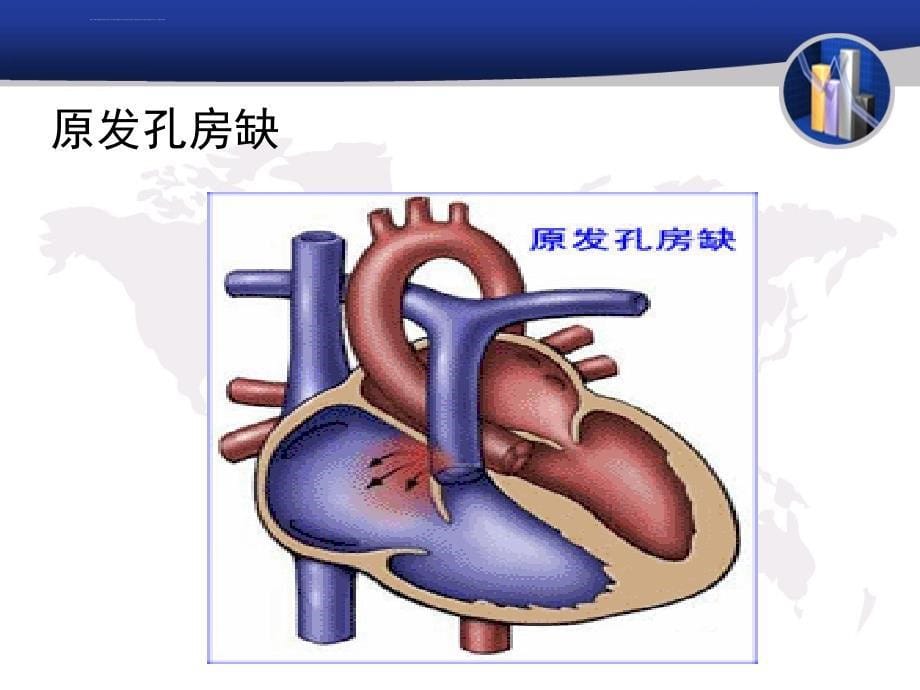 常见的心脏外科疾病简述ppt课件_第5页