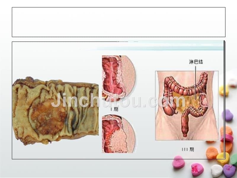 恶性肿瘤病人常见症状的护理ppt课件_第5页