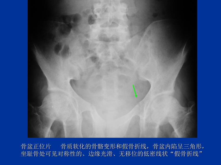 代谢性骨病4ppt课件_第4页