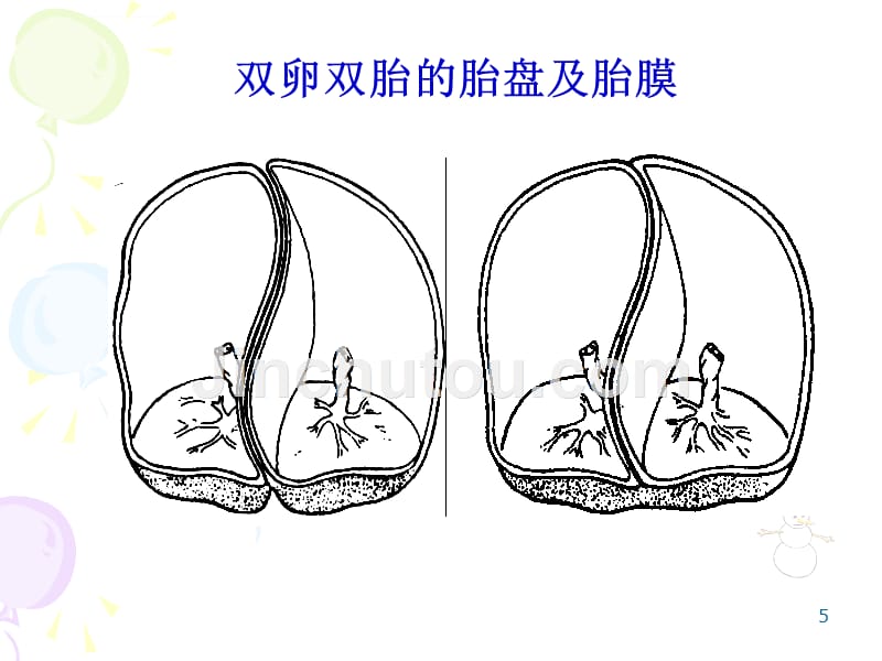 多胎妊娠与巨大胎儿教学课件幻灯_第5页