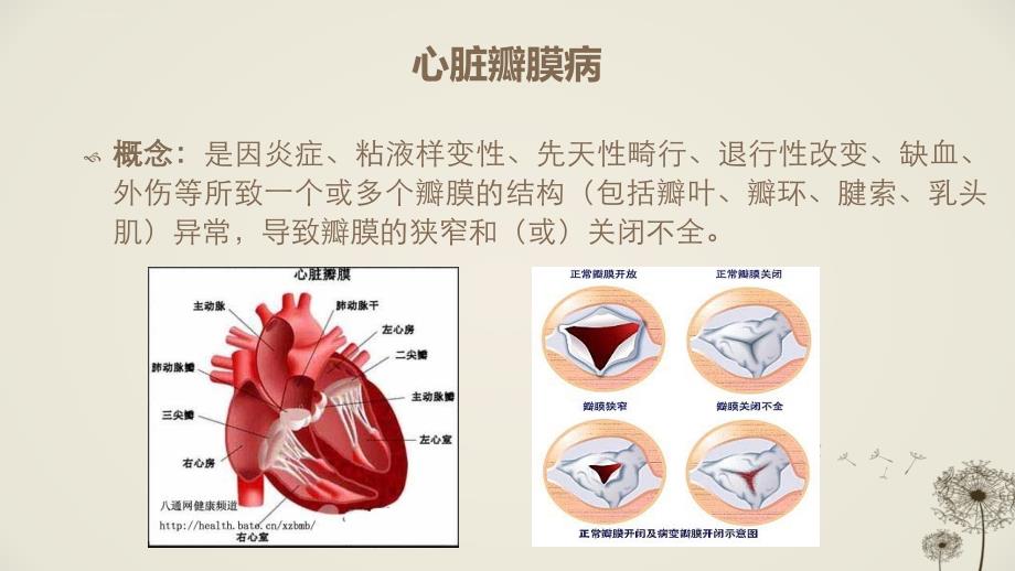 二尖瓣狭窄ppt课件_第3页