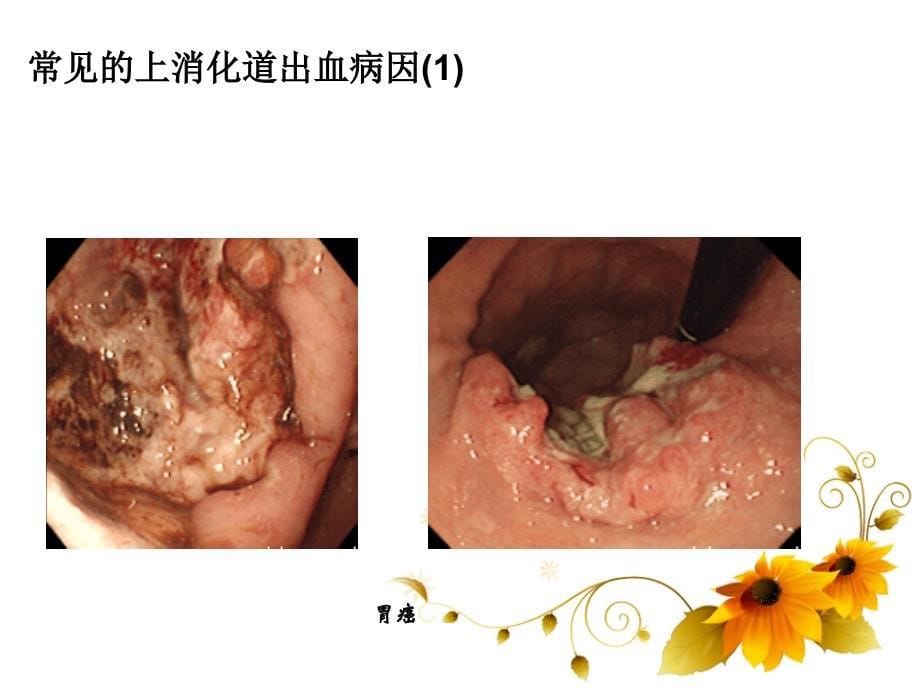 消化道出血及护理ppt课件_第5页