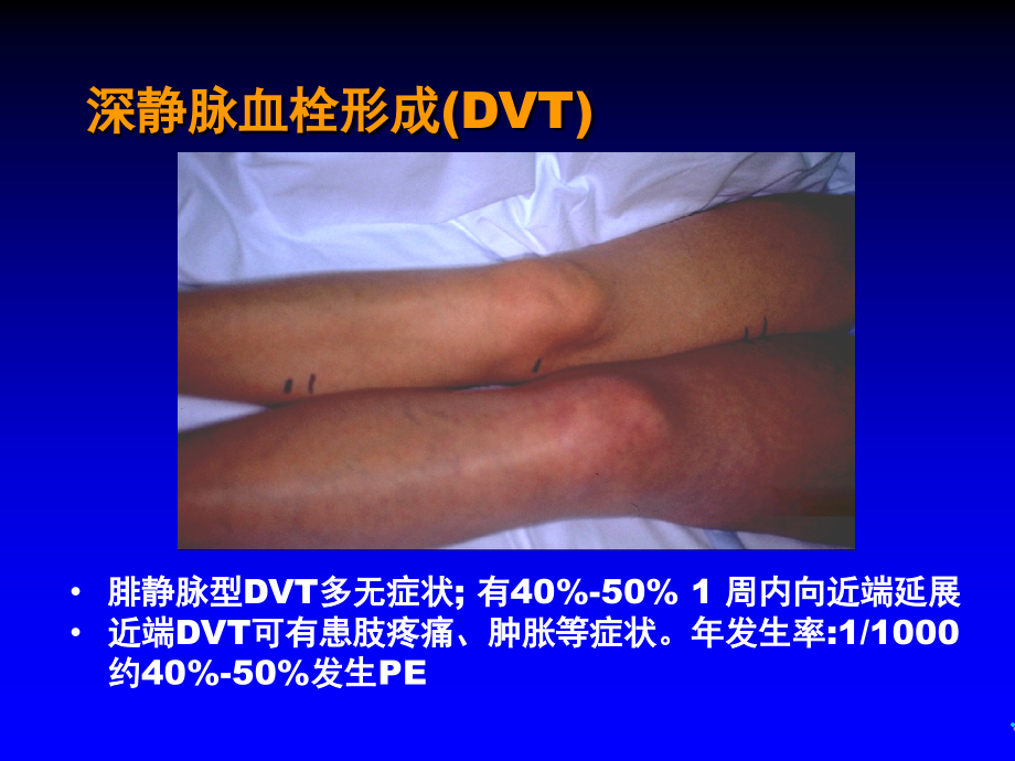 医学ppt静脉血栓栓塞新稿_第4页