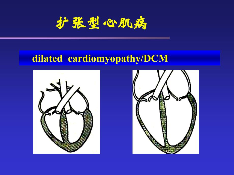 心肌疾病教学课件_第4页