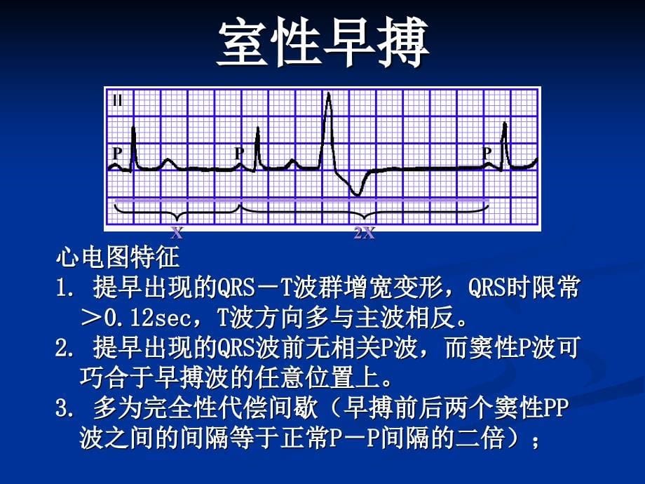 心律失常实验诊断ppt课件_第5页