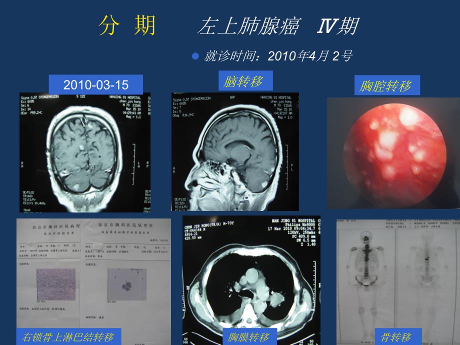 易瑞沙青岛病例分享ppt课件_第4页