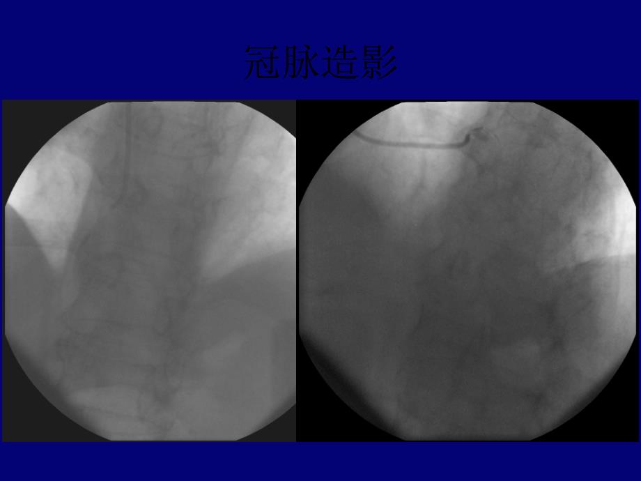 用于急诊pci术两例病例报告_第4页