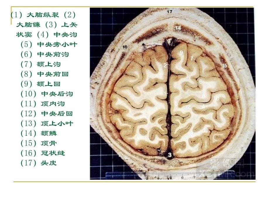 人体断层解剖图谱大脑_第5页