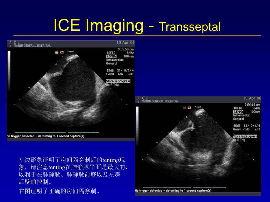 心内超声和心电生理英文课件_第4页
