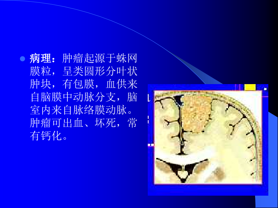 脑膜瘤的影像学诊断ppt课件_第4页