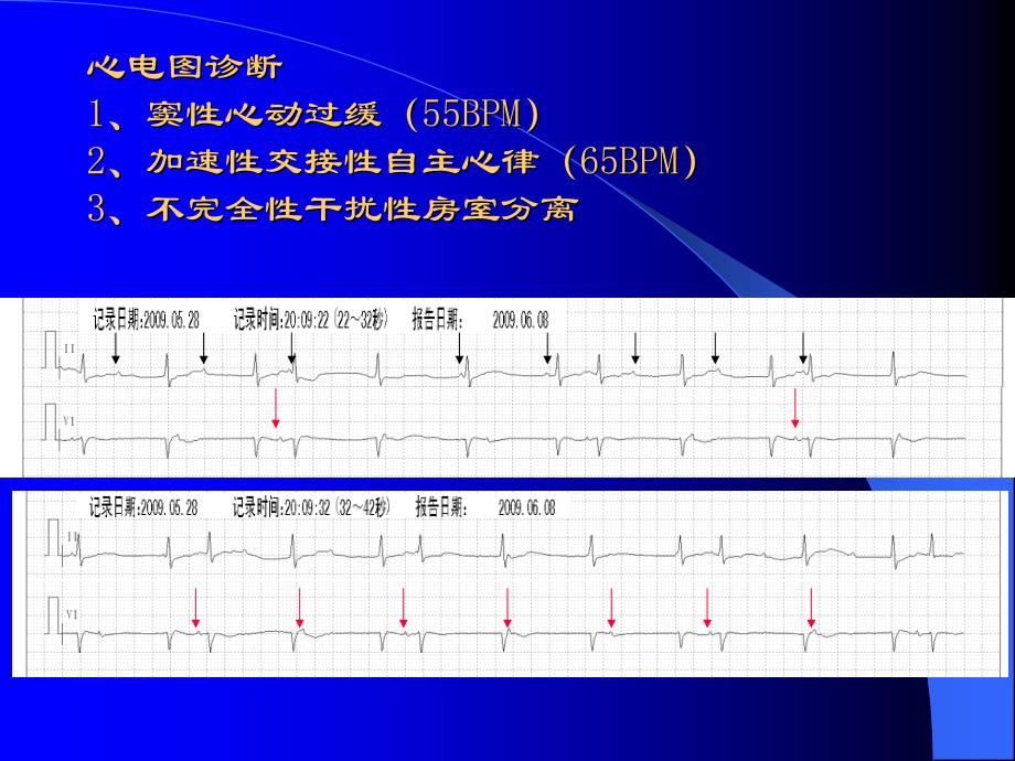 心律失常（心内科）ppt课件_第3页