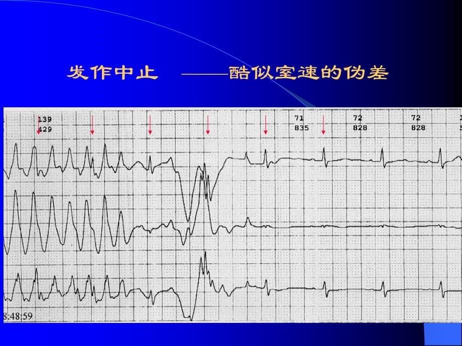 心律失常（心内科）ppt课件_第5页