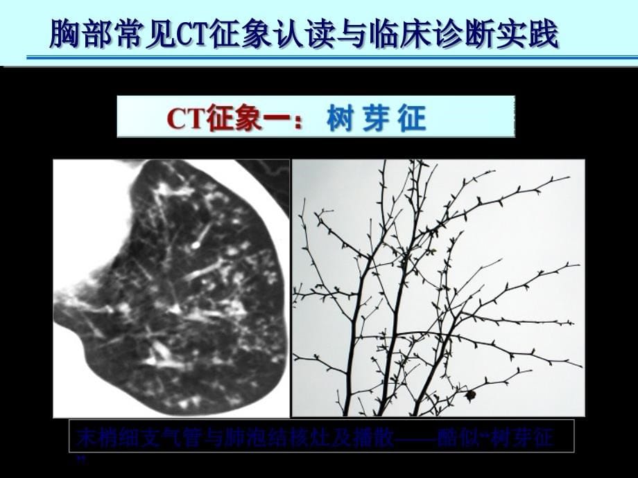 医学ppt肺ct十大征象诊断应用_第5页