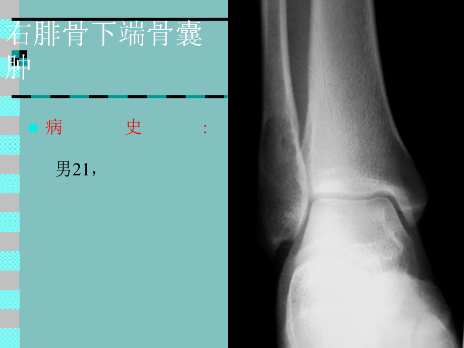 右腓骨下端骨囊肿_第1页