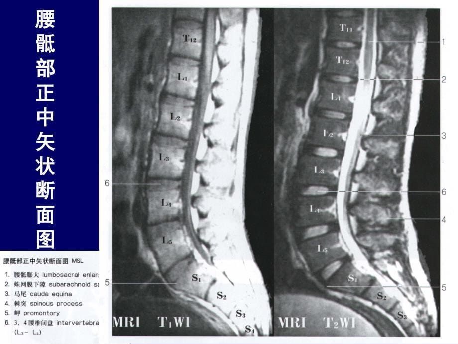 影像诊断脊柱区腰段断层解剖ppt课件_1(1)_第5页