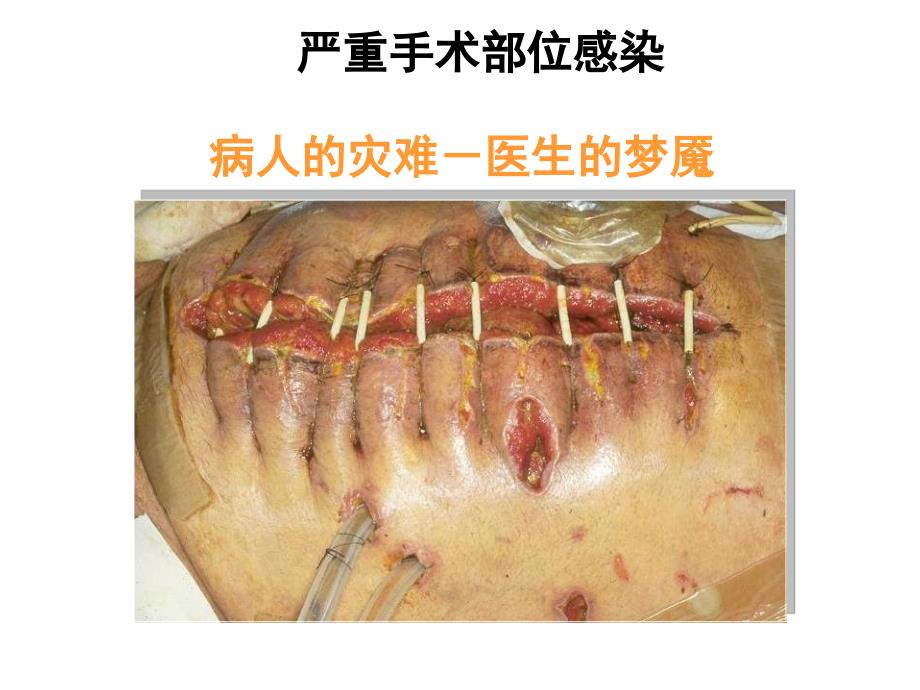 预防性抗菌素与外科部位感染控制46170ppt课件_第4页