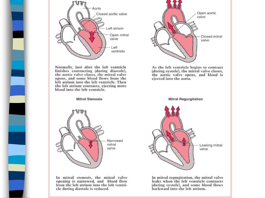 心脏瓣膜病教学课件_第5页