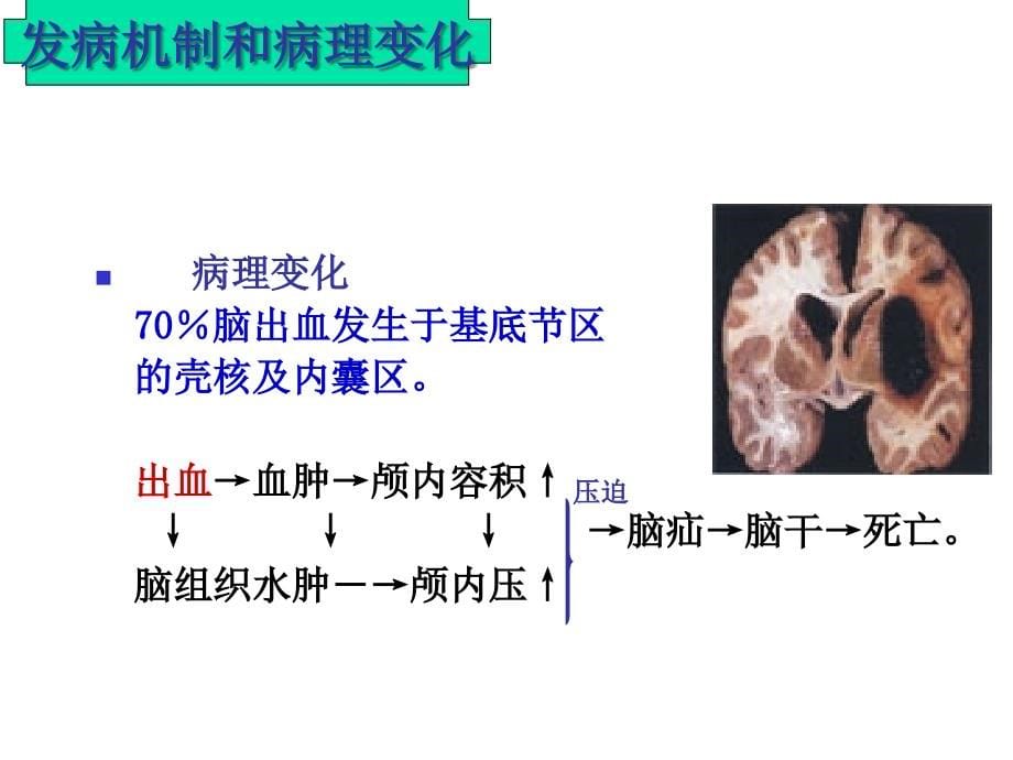 脑出血的护理PPT课件_第5页