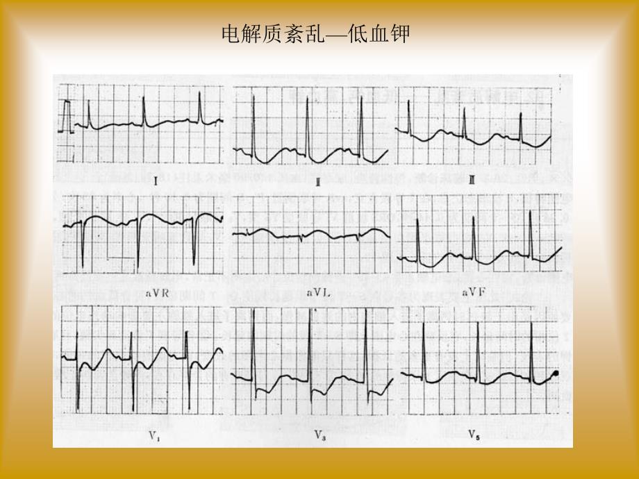 职业医师考试心电图及影像考试题答案_第3页