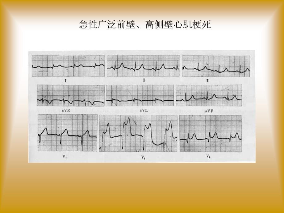 职业医师考试心电图及影像考试题答案_第5页