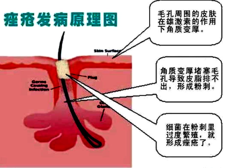 脸上的不速之客—痤疮_第4页