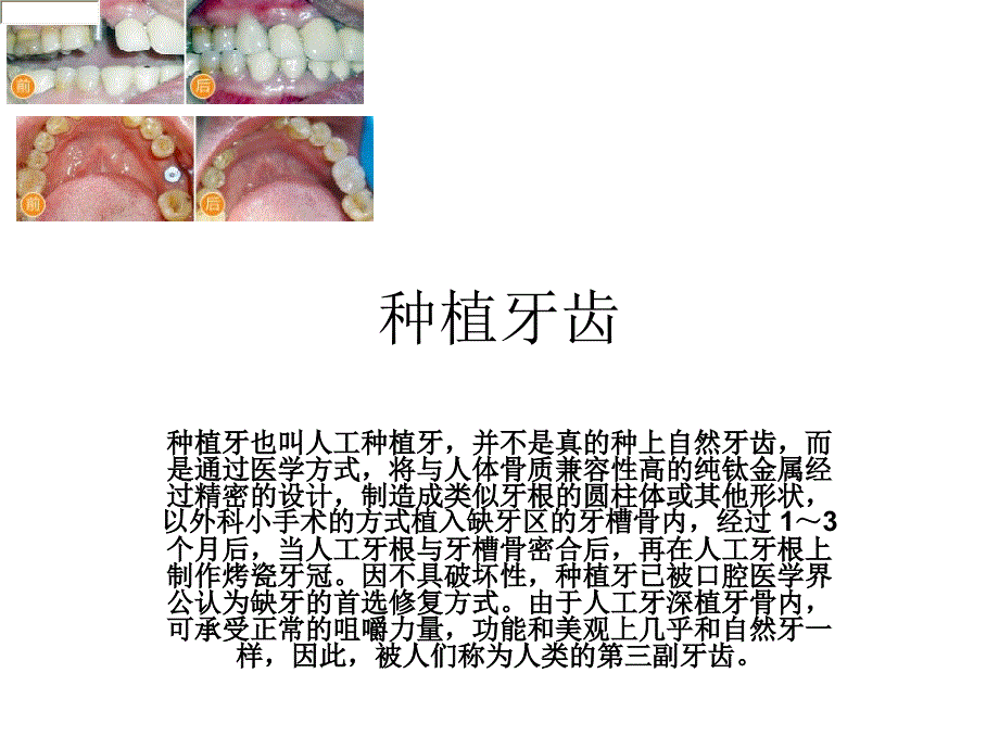 种植牙齿演示文稿_第1页