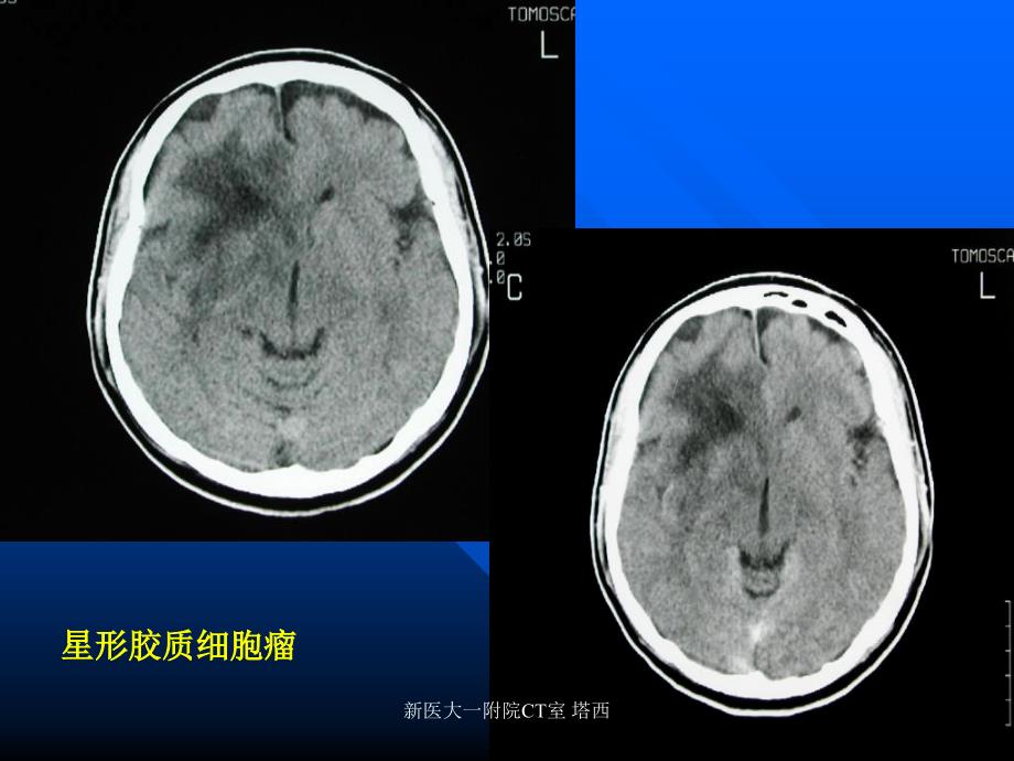 脑部疾病诊断1_第1页