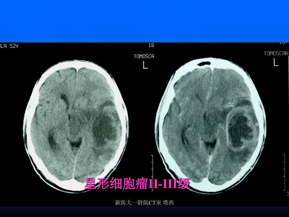 脑部疾病诊断1_第2页