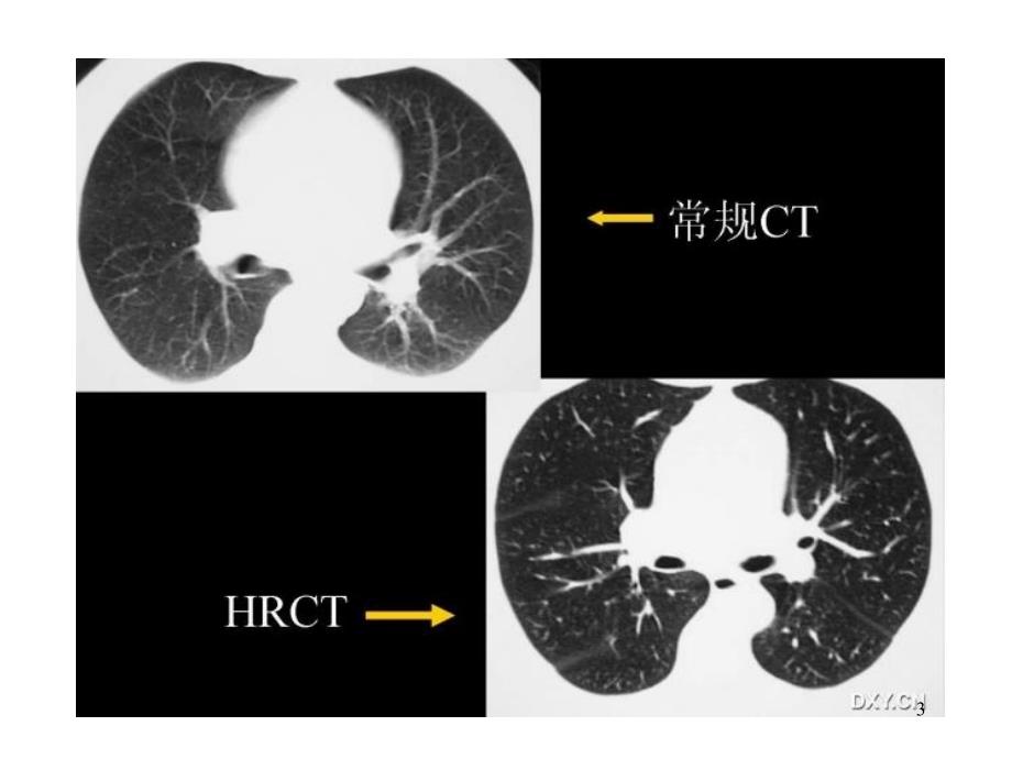 HRCT在弥漫性肺病诊断中的应用PPT课件_第3页