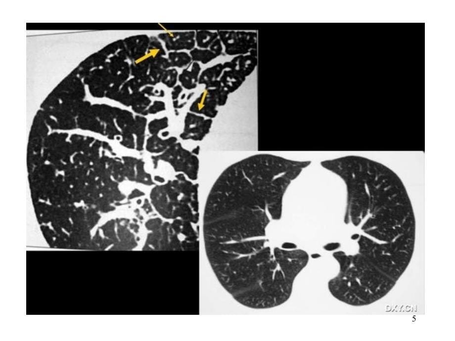 HRCT在弥漫性肺病诊断中的应用PPT课件_第5页