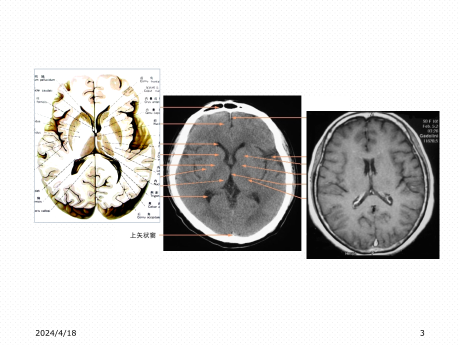 CT基础颅脑正常和基本病变表现PPT课件_第3页
