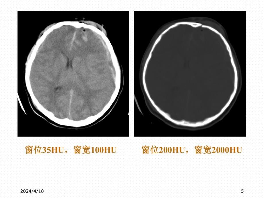 CT基础颅脑正常和基本病变表现PPT课件_第5页