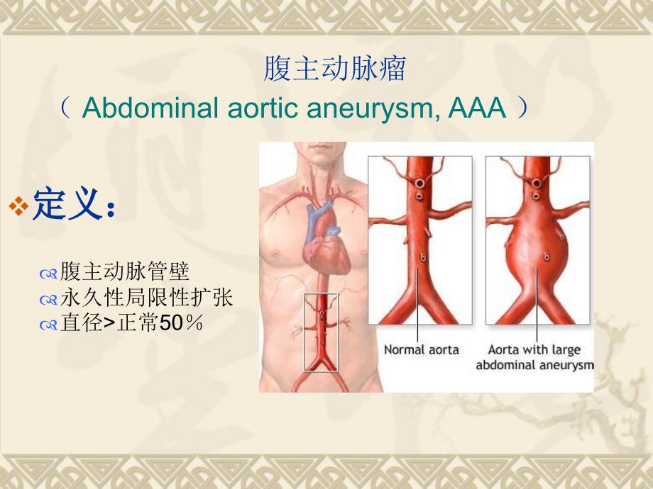 腹主动脉瘤之护理教学查房_第4页