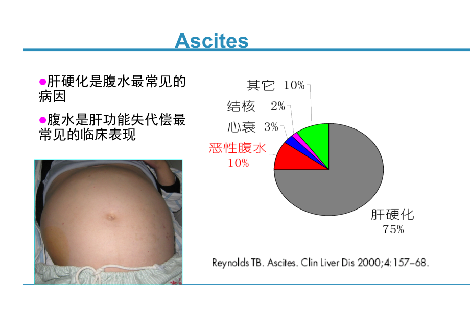 肝硬化腹水规范性诊治_北京肝腹水治疗医院_第2页