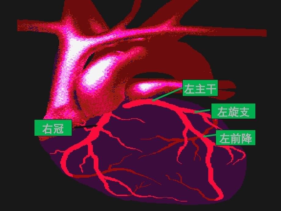 冠状动脉粥样硬化性心脏病88_第5页