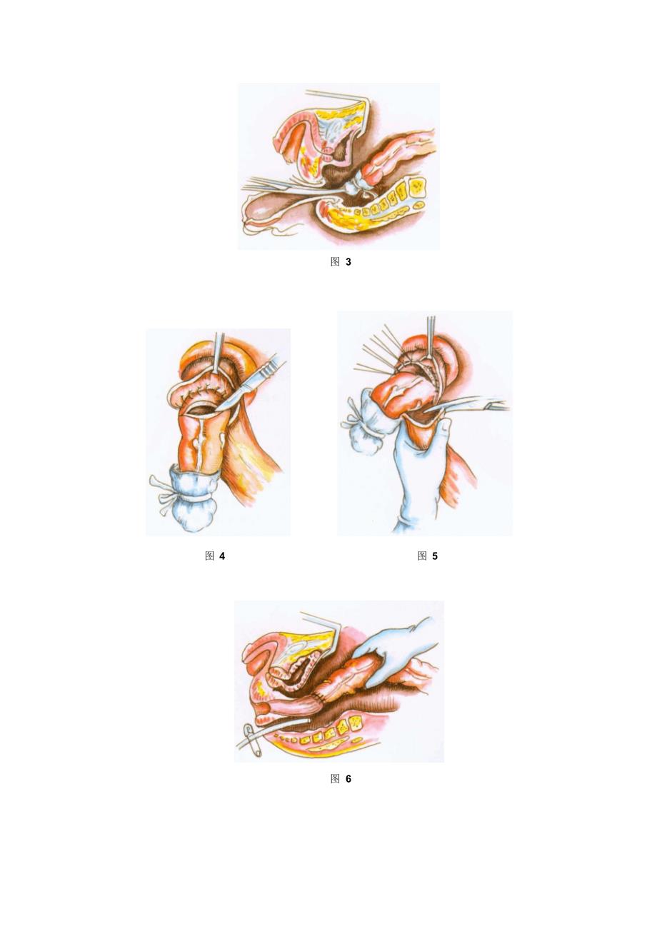 保留肛门括约肌的直肠切除术_第2页