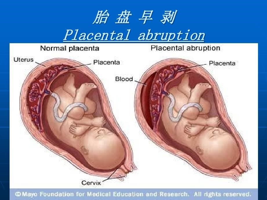 胎盘早剥并发凝血功能障碍的诊治PPT课件_第5页